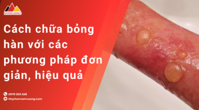 Cách chữa bỏng hàn